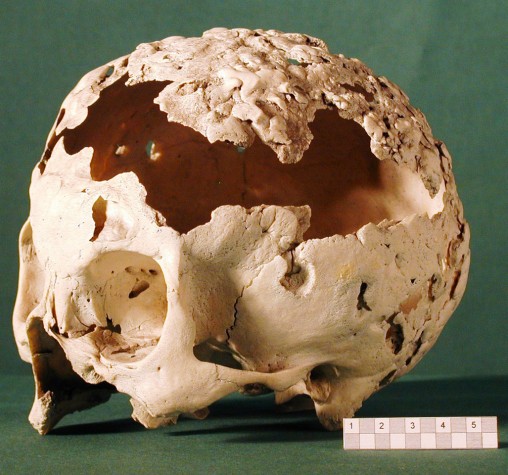Objekt des Monats Syphilisschädel